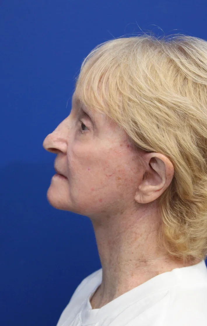 Facelift Before & After Patient #5279