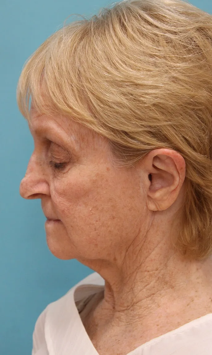 Facelift Before & After Patient #5279