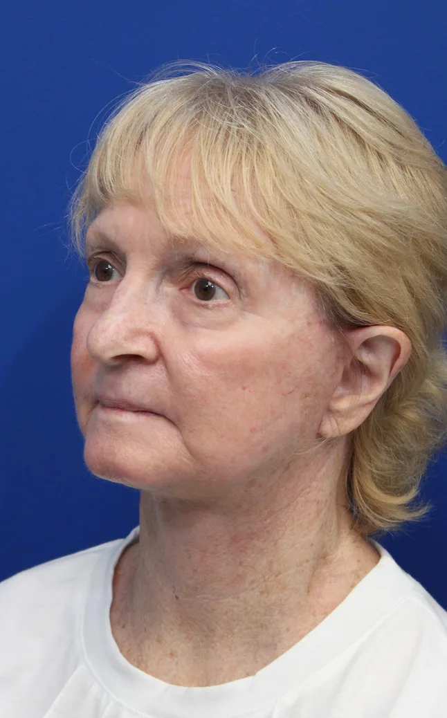 Facelift Before & After Patient #5279
