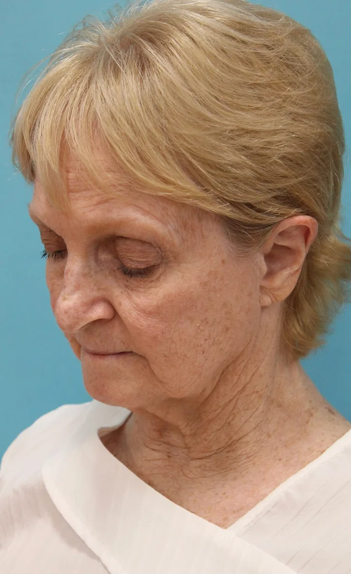 Facelift Before & After Patient #5279