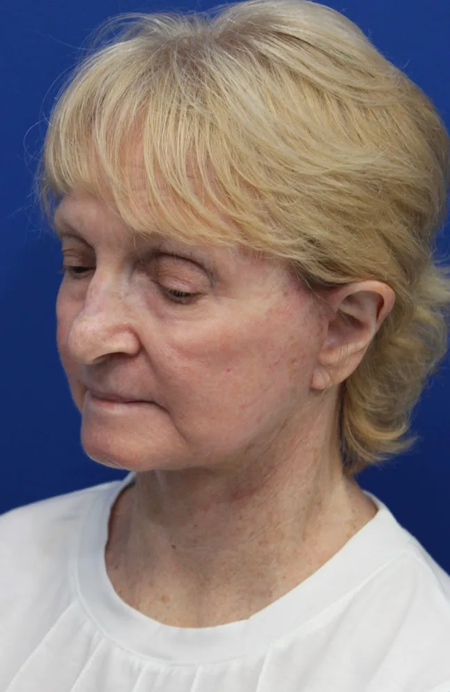Facelift Before & After Patient #5279