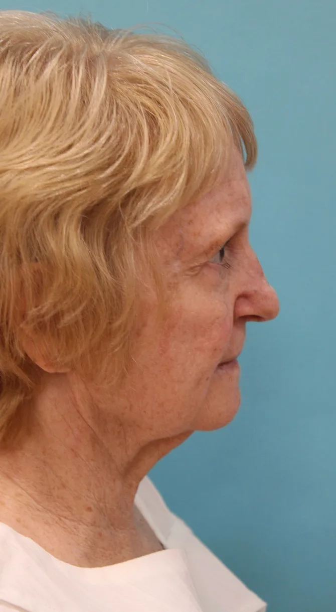 Facelift Before & After Patient #5279