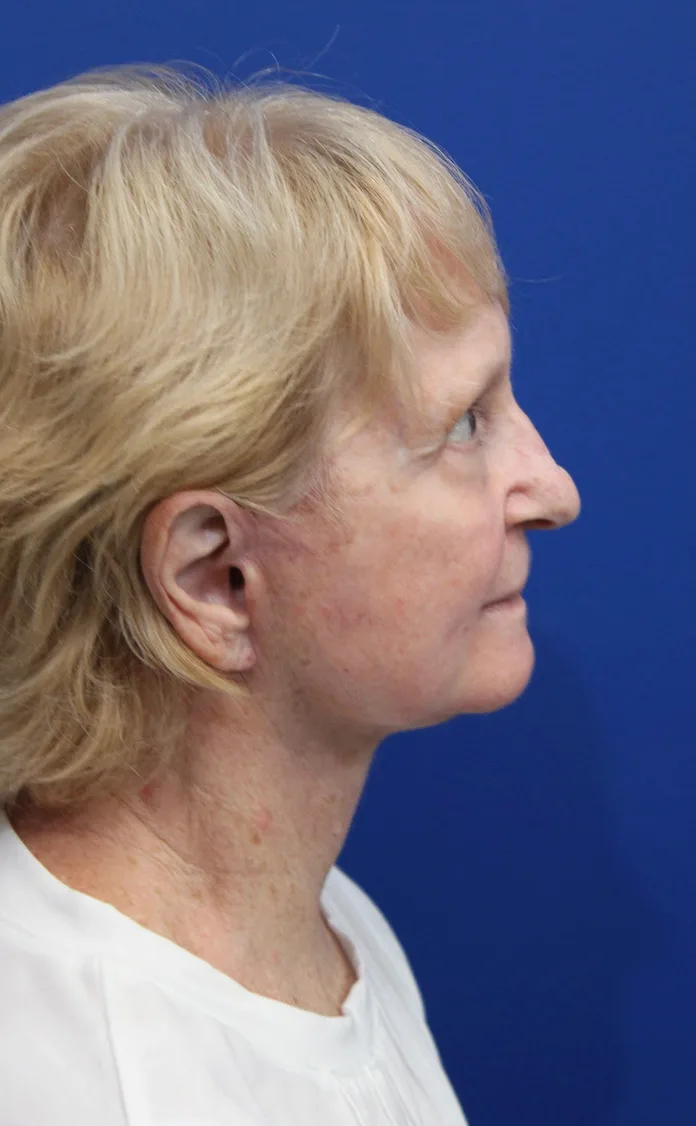 Facelift Before & After Patient #5279