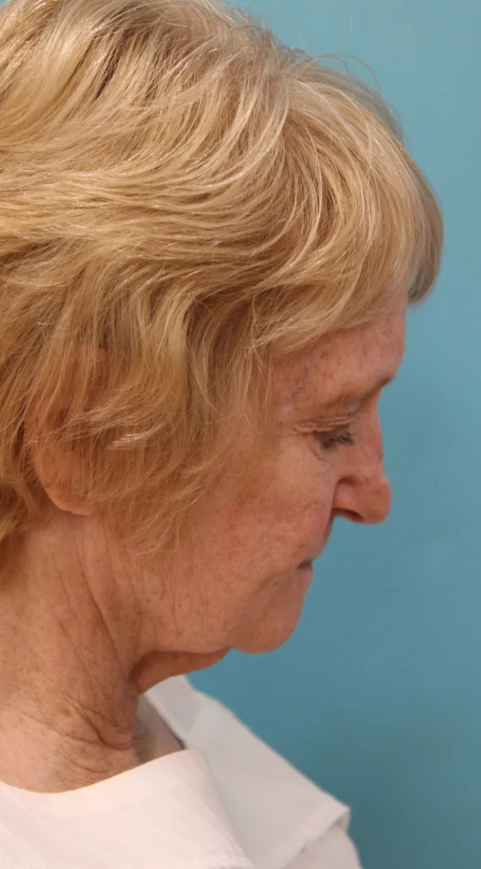 Facelift Before & After Patient #5279