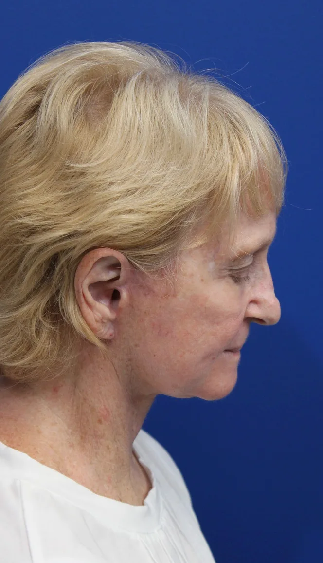 Facelift Before & After Patient #5279