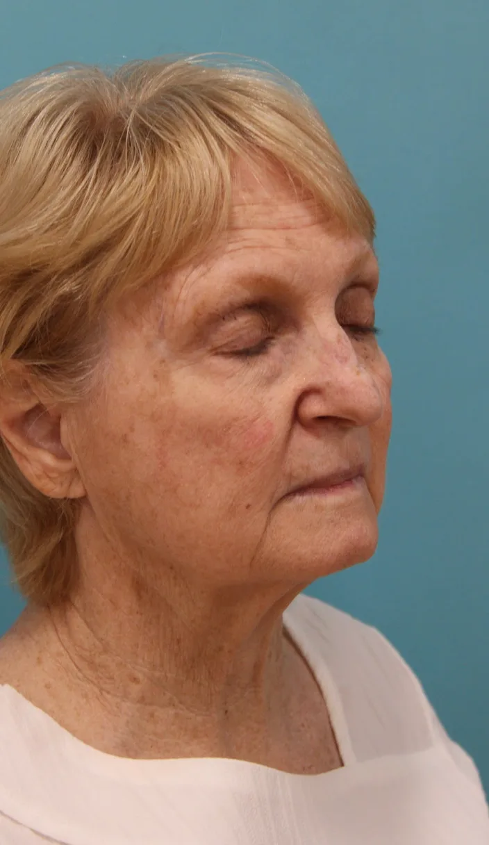 Facelift Before & After Patient #5279