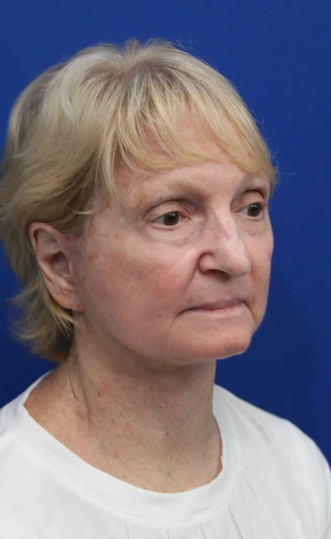 Facelift Before & After Patient #5279