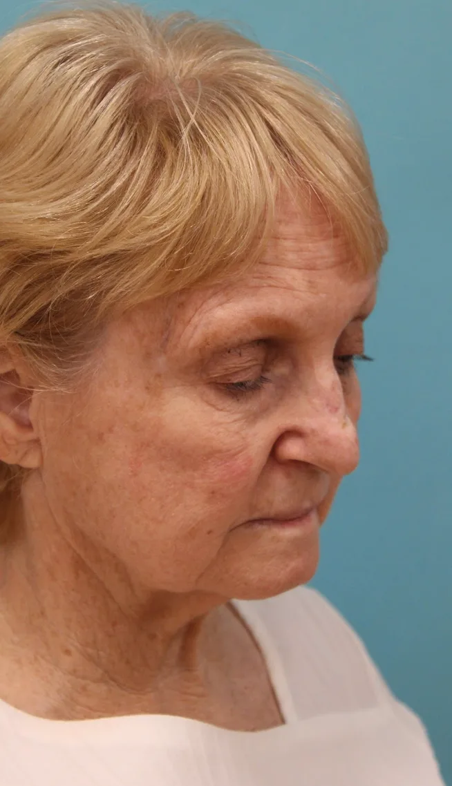 Facelift Before & After Patient #5279