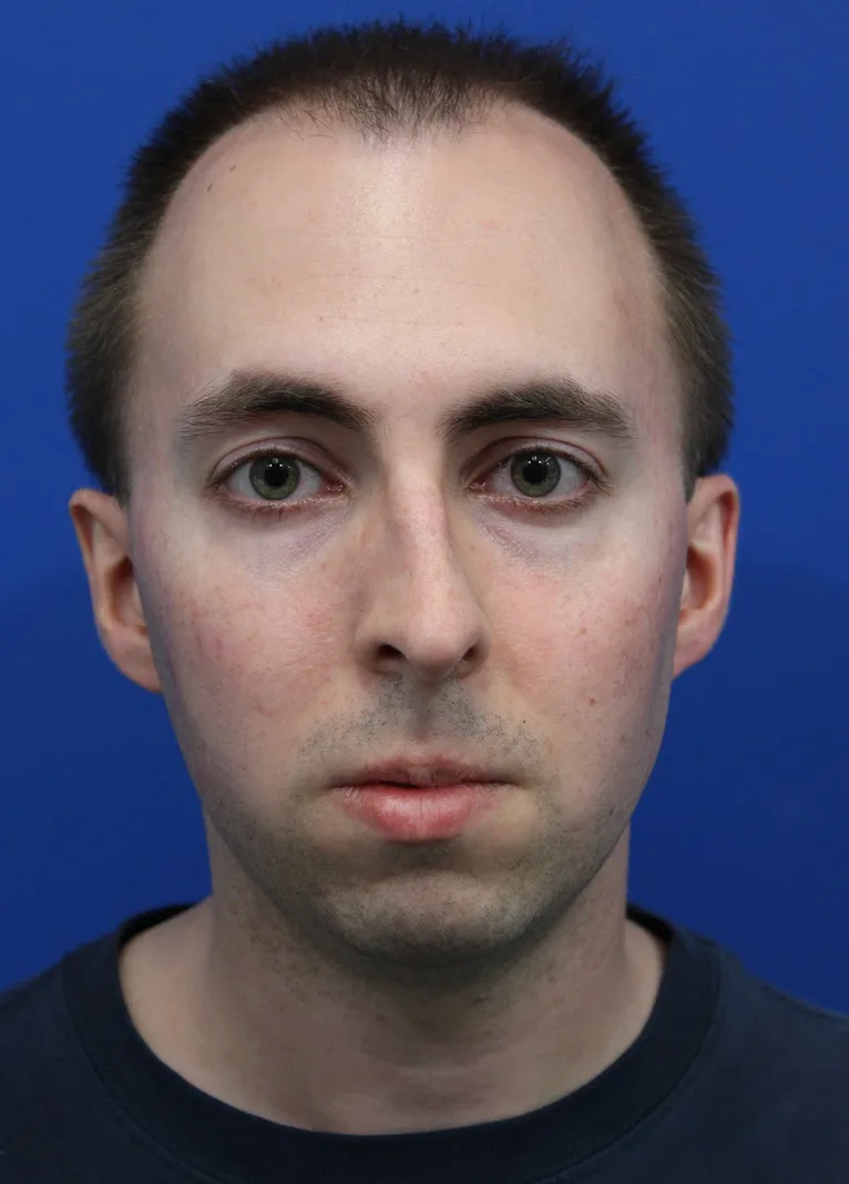 Deep Neck Lift Before & After Patient #5479