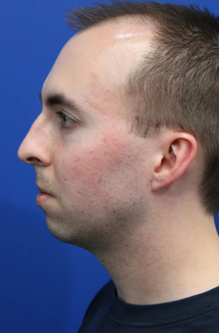 Chin Implant Before & After Patient #5498