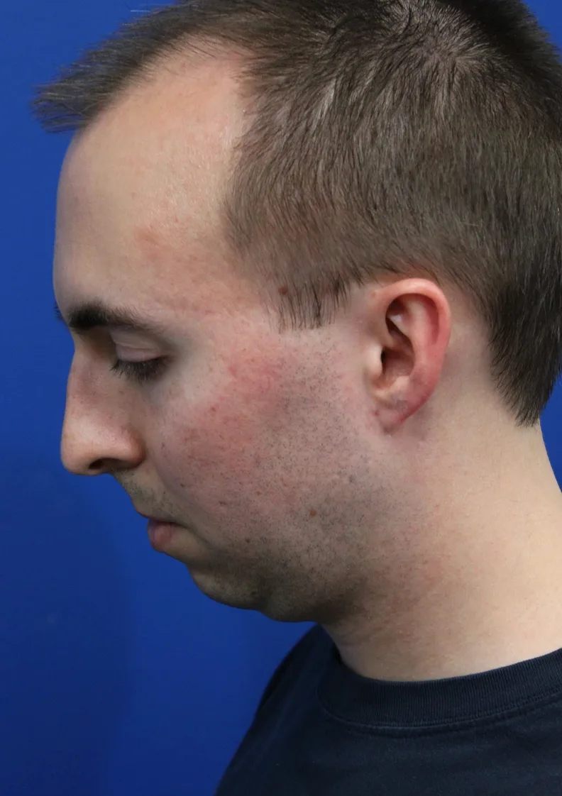 Chin Implant Before & After Patient #5498