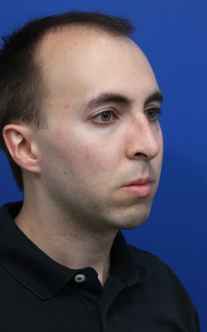 Chin Implant Before & After Patient #5498