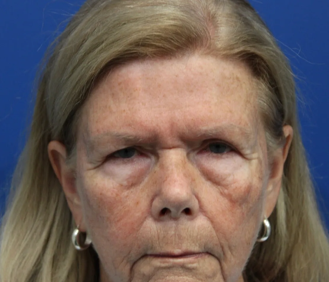 Brow Lift Before & After Patient #5424