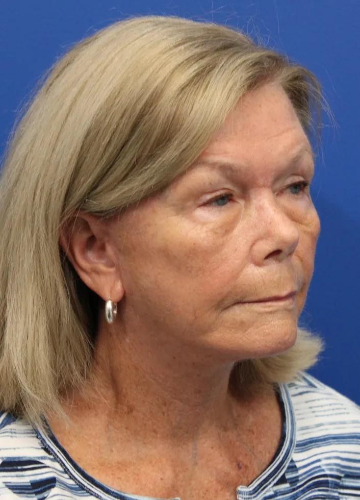Facelift Before & After Patient #5425