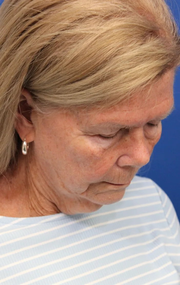Facelift Before & After Patient #5425