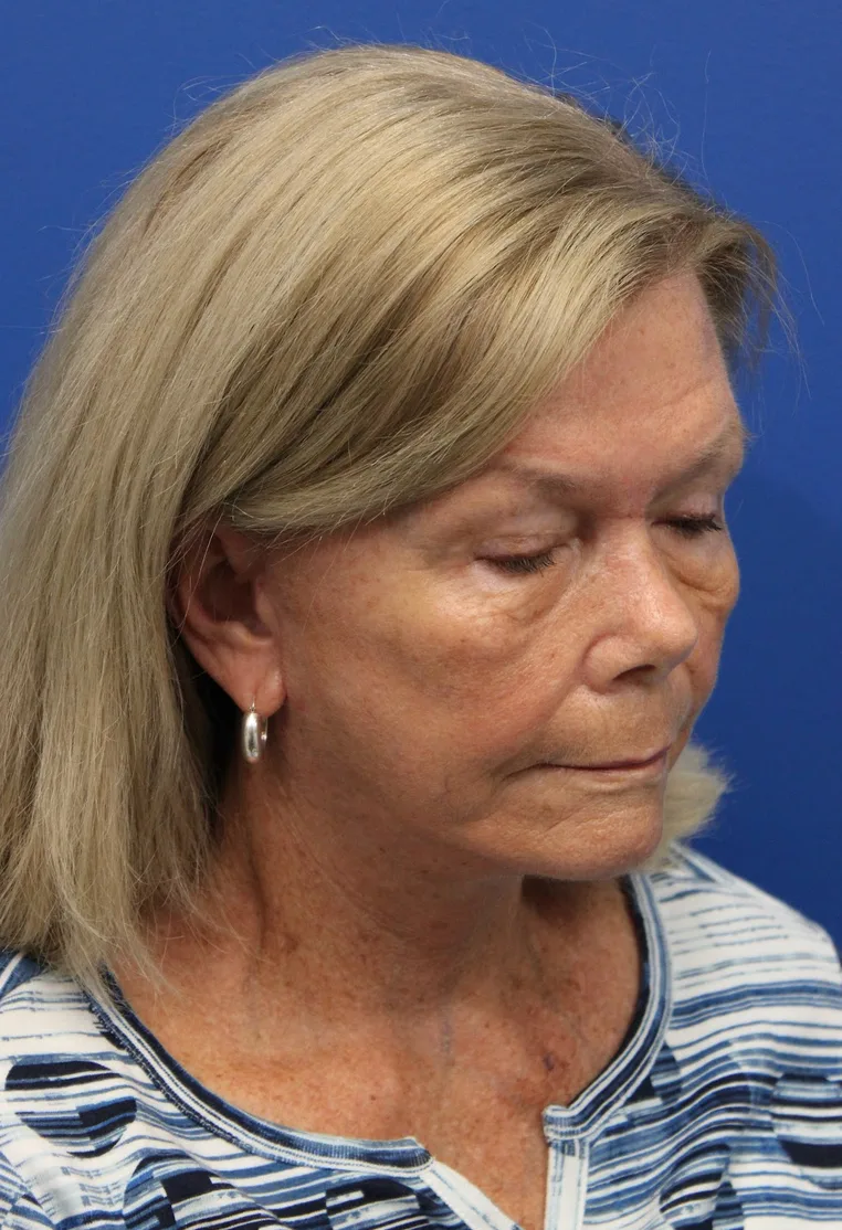 Facelift Before & After Patient #5425