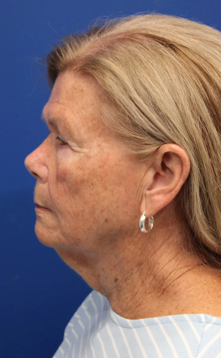 Facelift Before & After Patient #5425