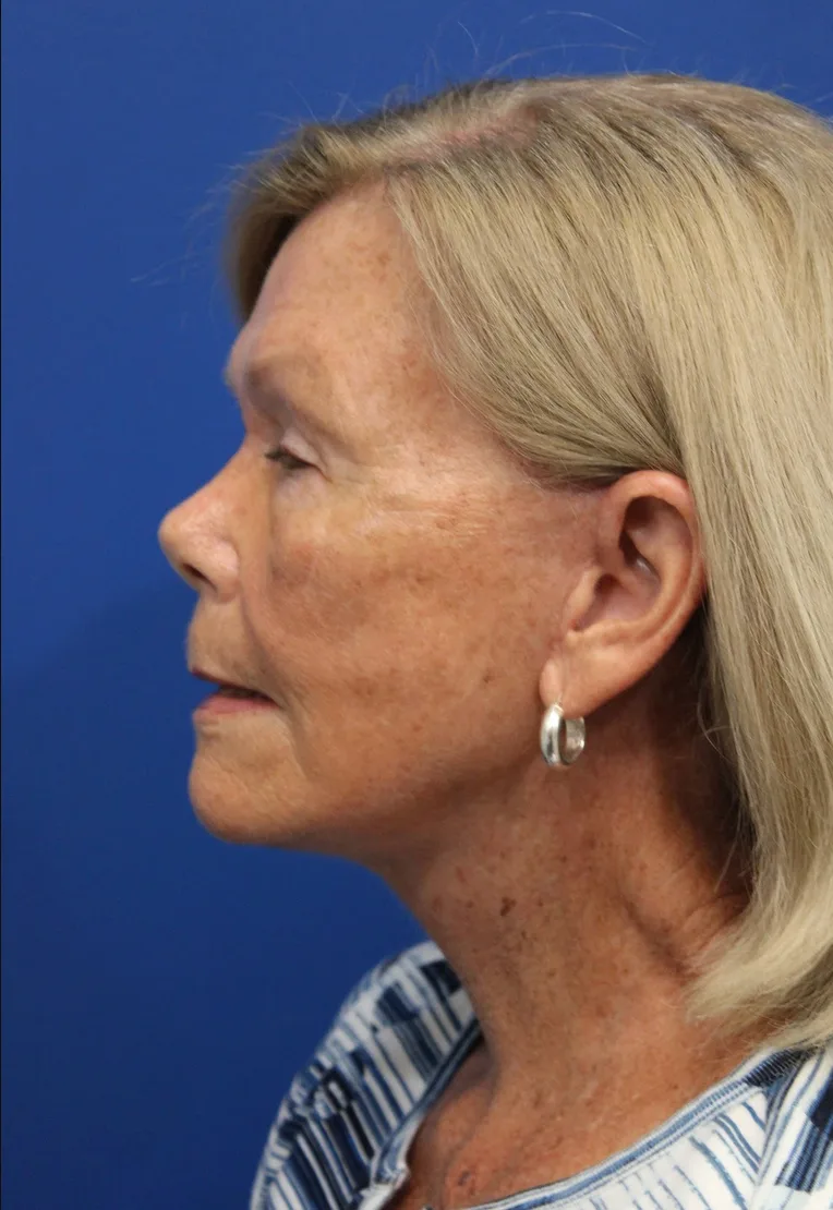Facelift Before & After Patient #5425