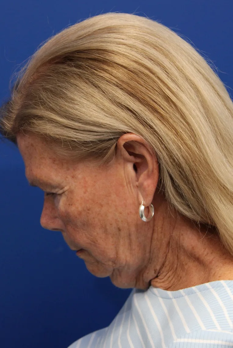 Facelift Before & After Patient #5425