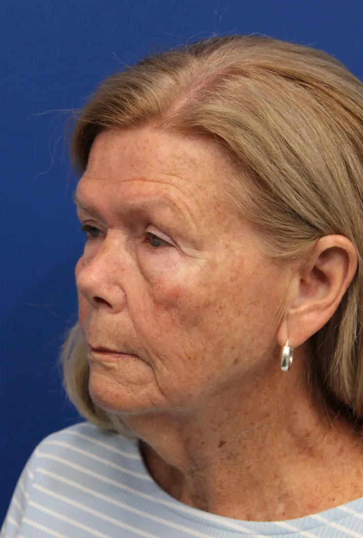 Facelift Before & After Patient #5425