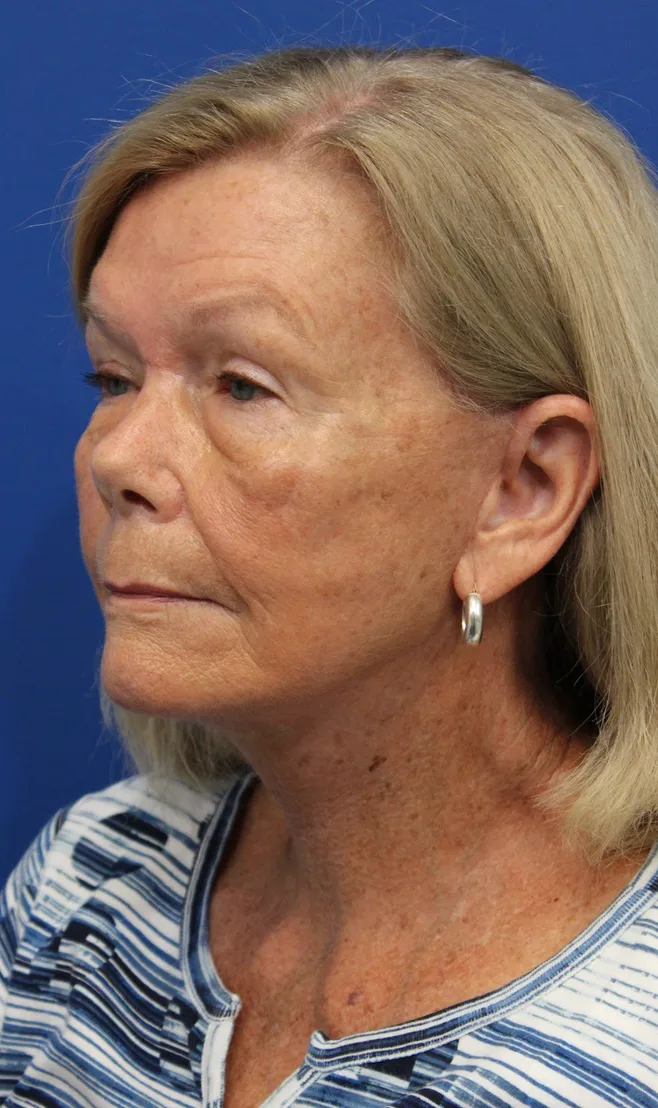 Facelift Before & After Patient #5425