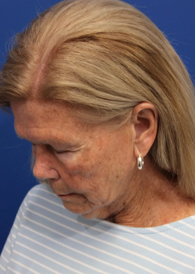 Facelift Before & After Patient #5425