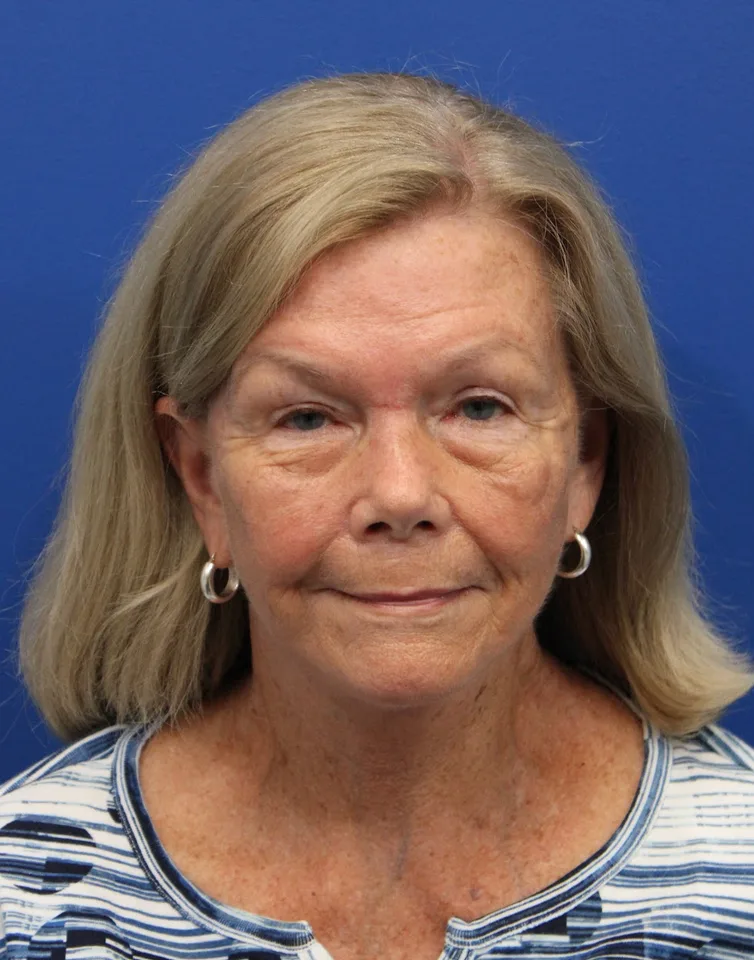 Facelift Before & After Patient #5425