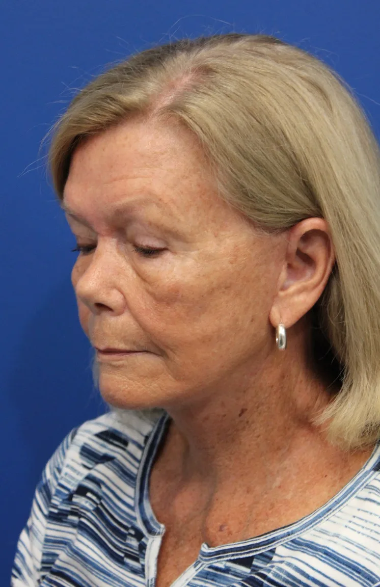 Facelift Before & After Patient #5425