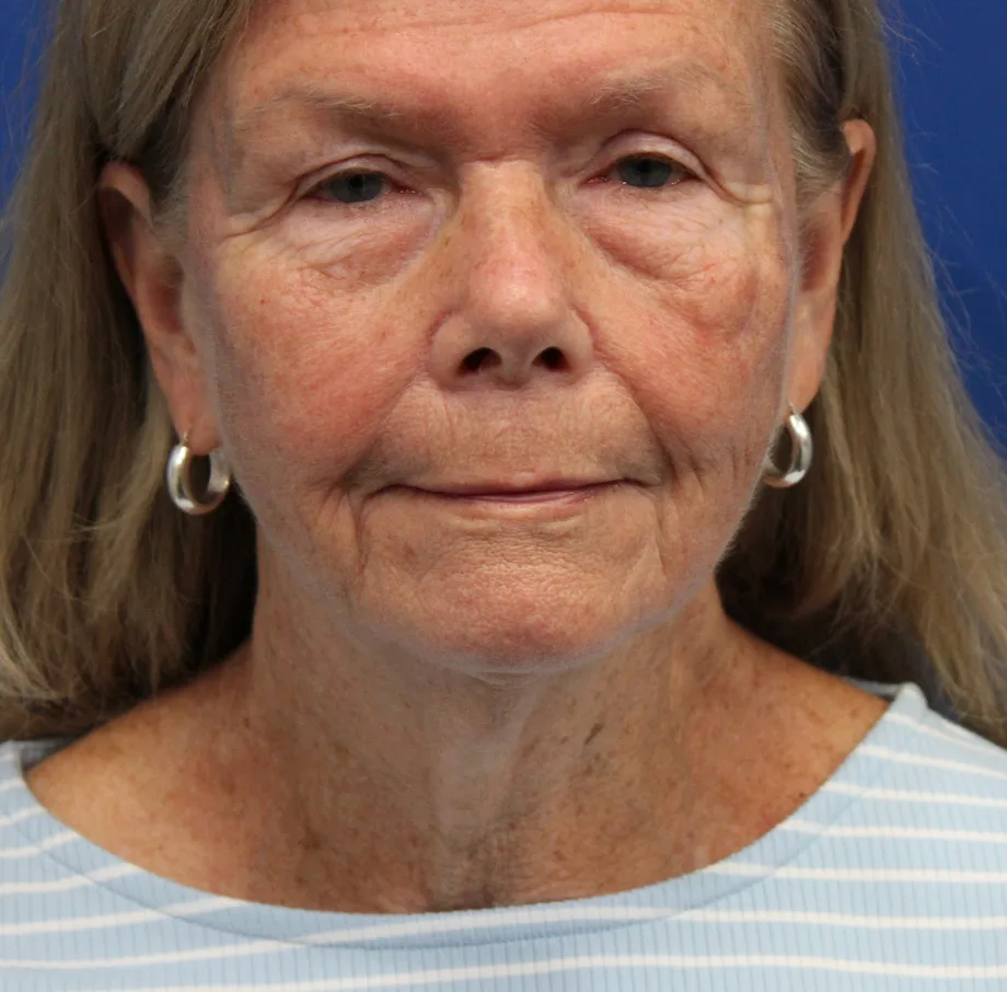 Facelift Before & After Patient #5425