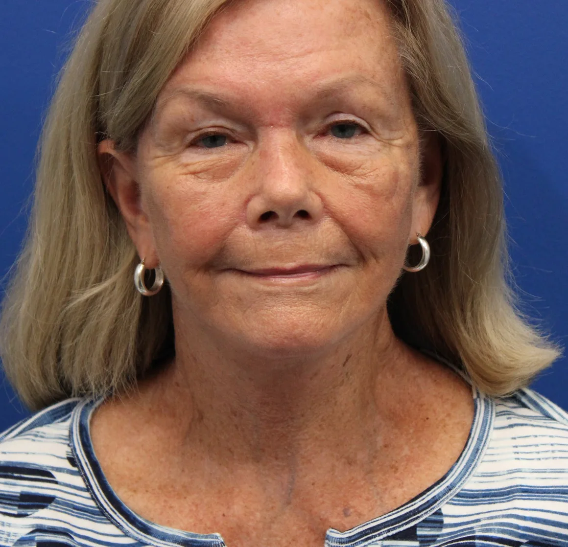 Facelift Before & After Patient #5425
