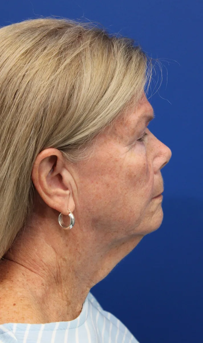 Facelift Before & After Patient #5425