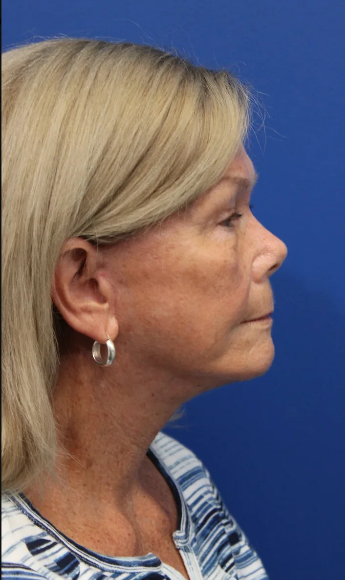 Facelift Before & After Patient #5425