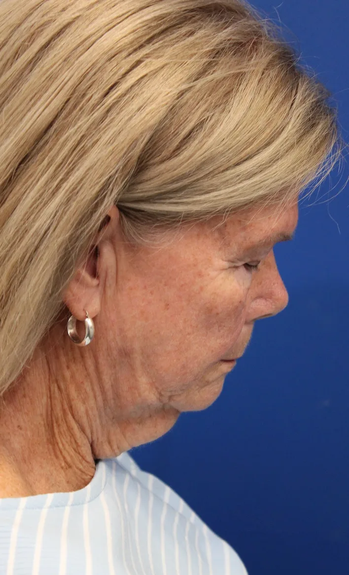 Facelift Before & After Patient #5425