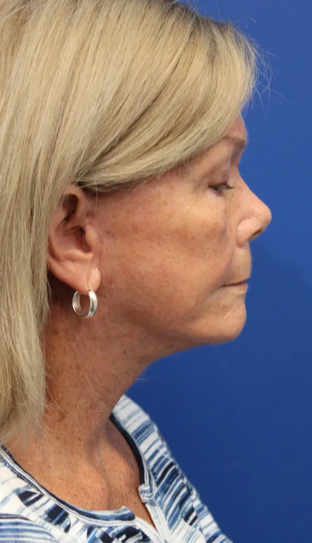 Facelift Before & After Patient #5425