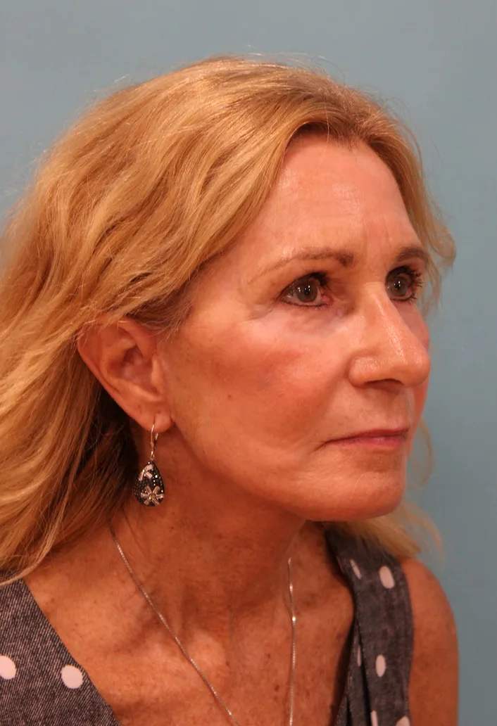 Laser Resurfacing Before & After Patient #5280