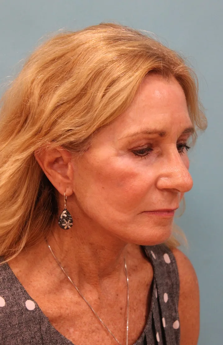 Laser Resurfacing Before & After Patient #5280