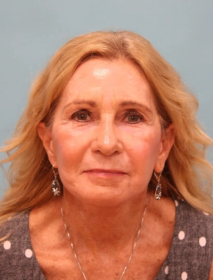 Laser Resurfacing Before & After Patient #5280