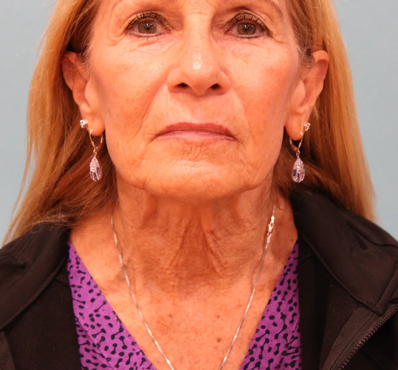 Laser Resurfacing Before & After Patient #5280