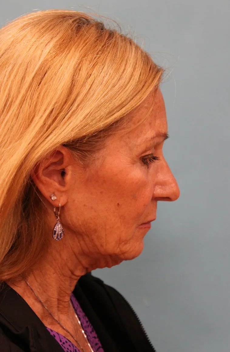Laser Resurfacing Before & After Patient #5280