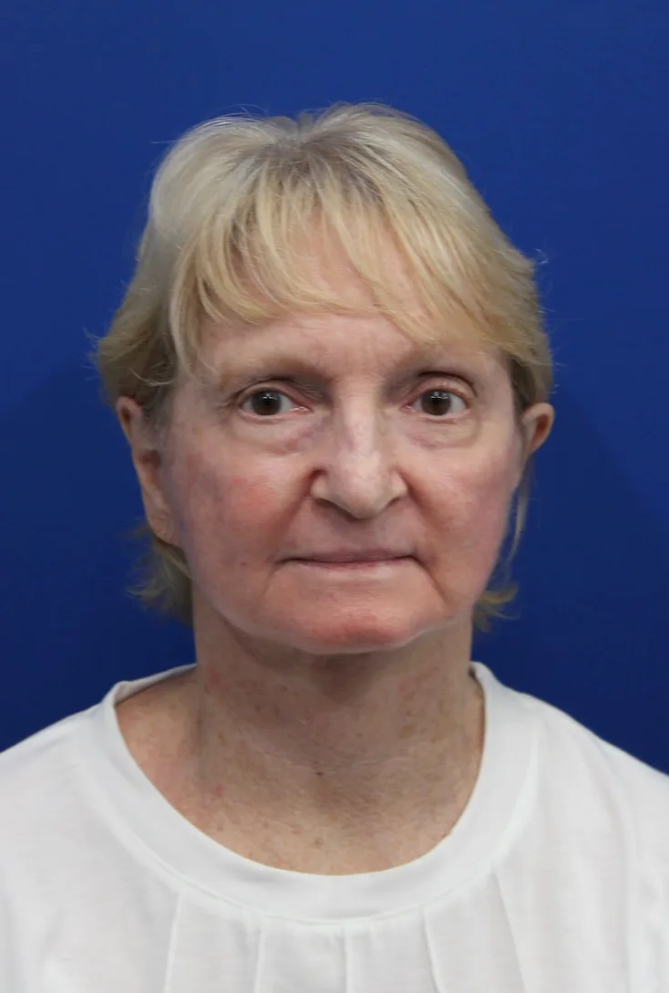 Laser Resurfacing Before & After Patient #5281