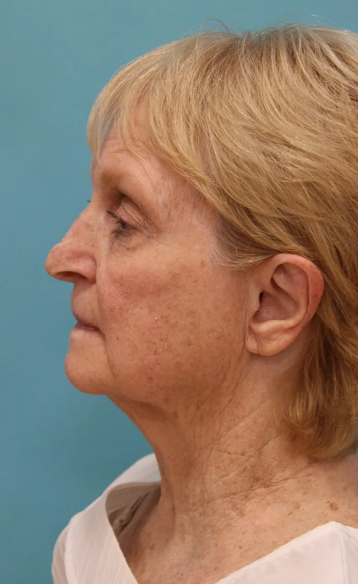Laser Resurfacing Before & After Patient #5281