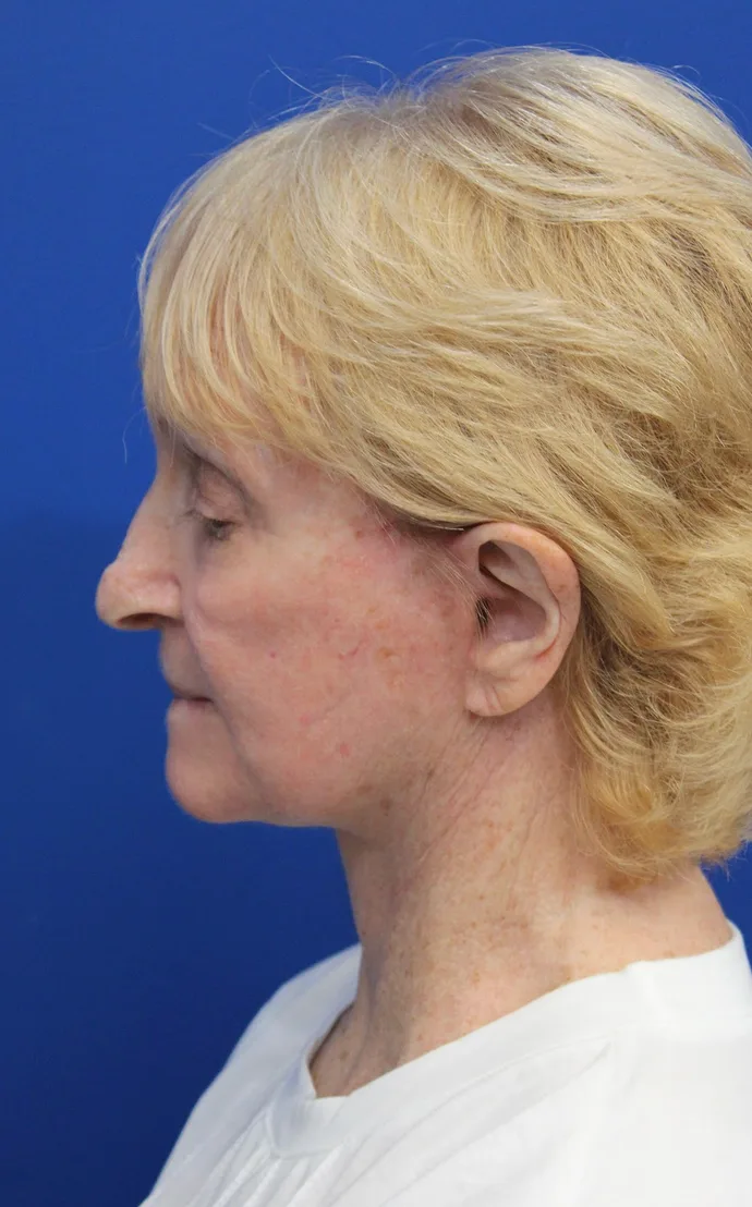Laser Resurfacing Before & After Patient #5281