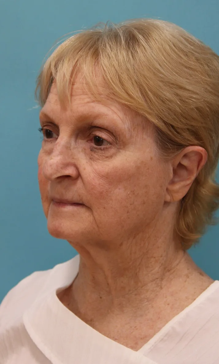 Laser Resurfacing Before & After Patient #5281
