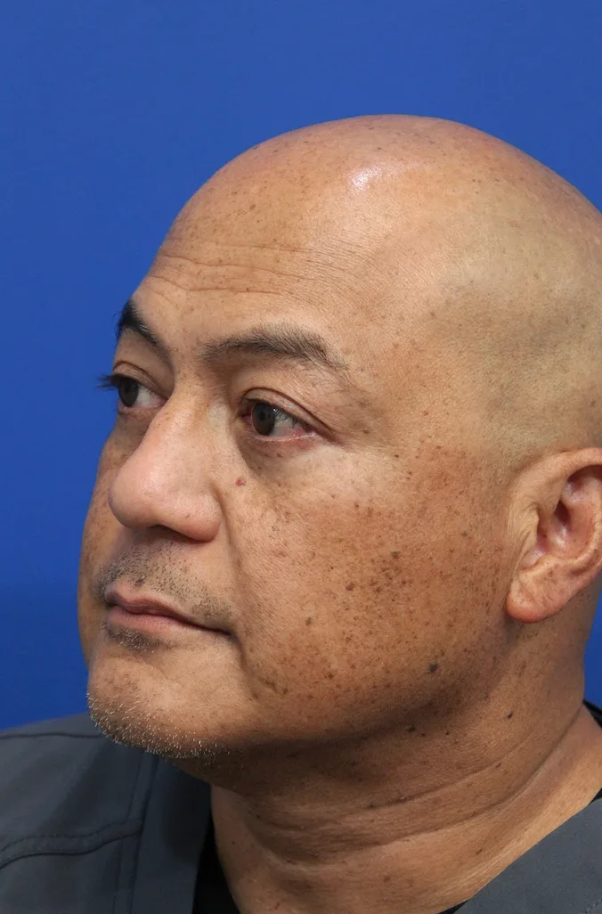 Lower Blepharoplasty Before & After Patient #5282