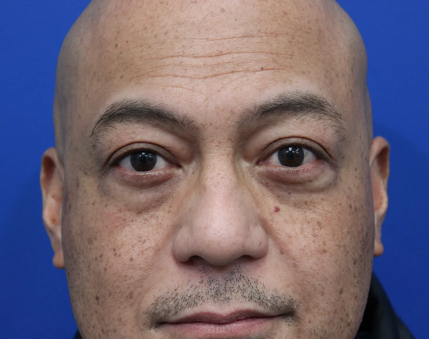 Lower Blepharoplasty Before & After Patient #5282