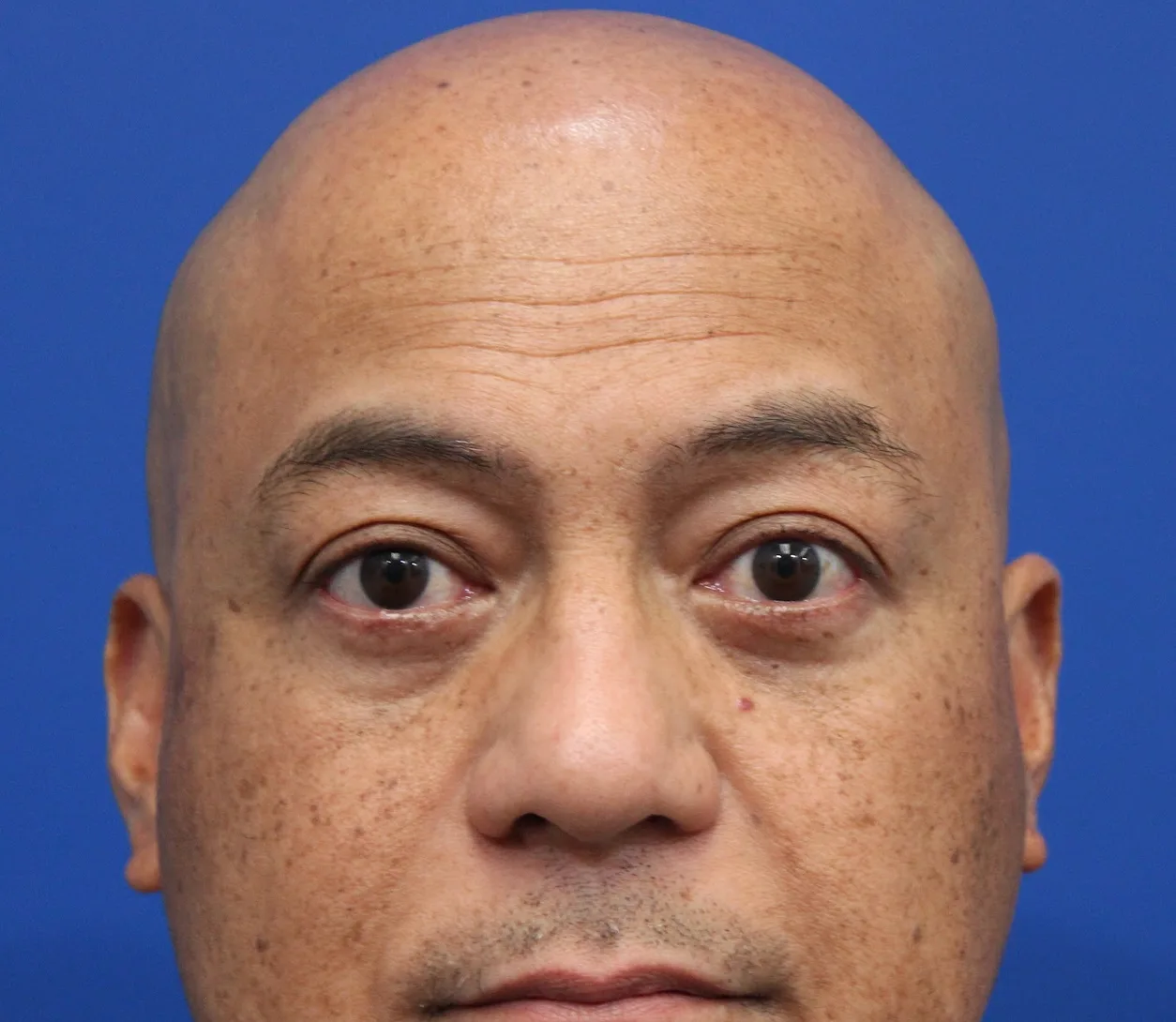 Lower Blepharoplasty Before & After Patient #5282