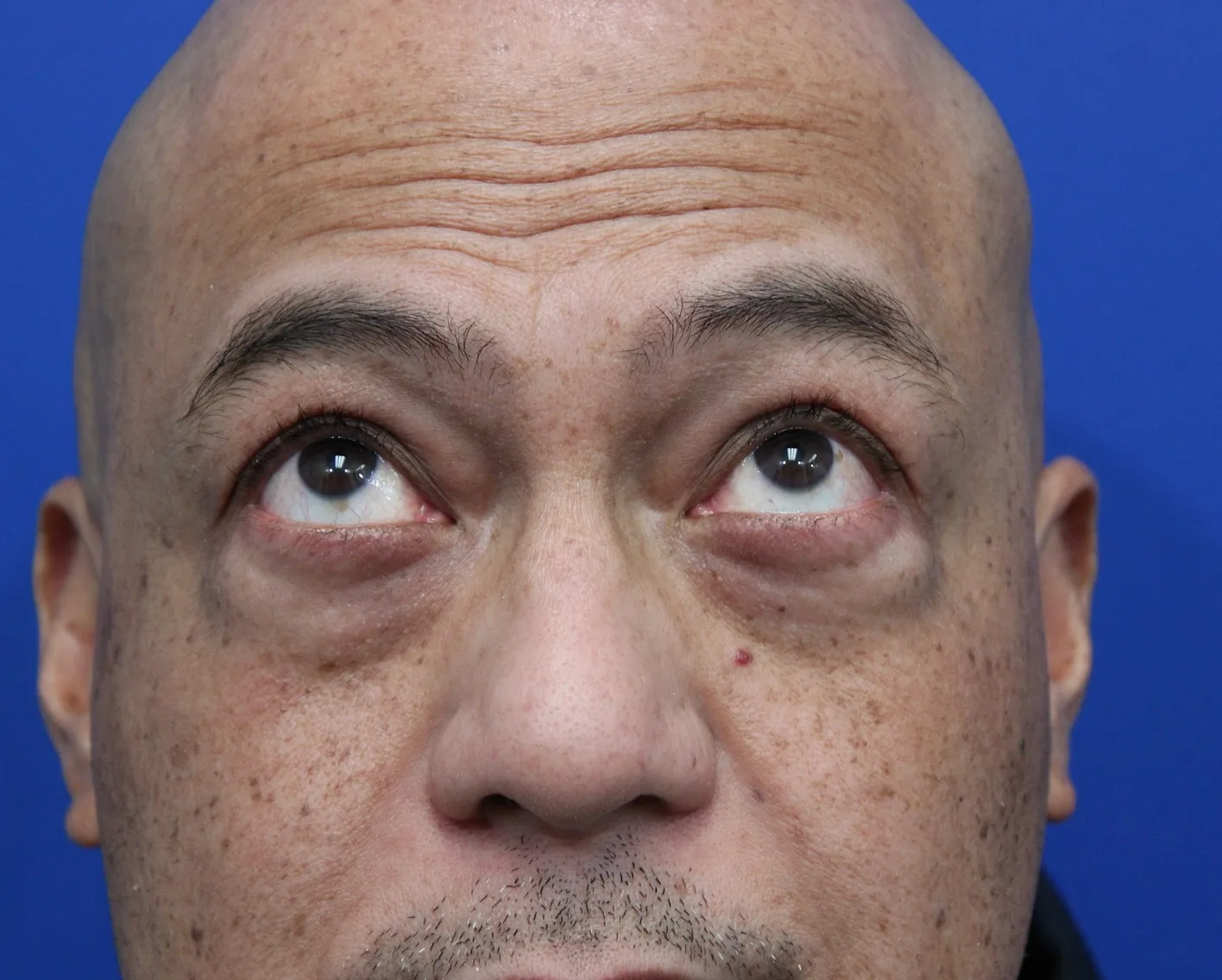 Lower Blepharoplasty Before & After Patient #5282
