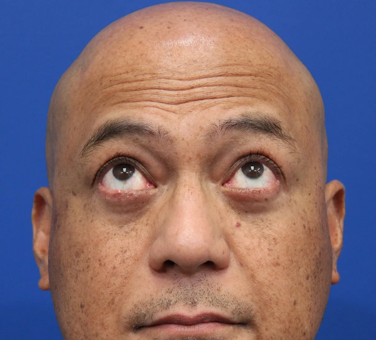 Lower Blepharoplasty Before & After Patient #5282