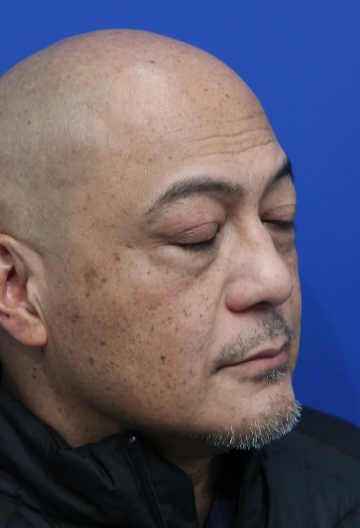 Lower Blepharoplasty Before & After Patient #5282