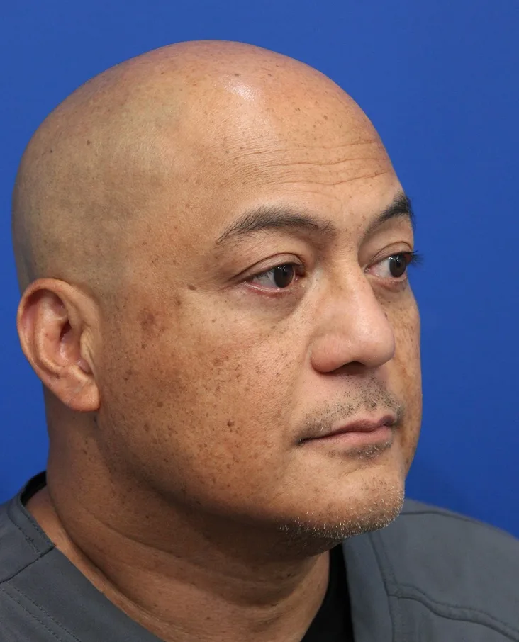 Lower Blepharoplasty Before & After Patient #5282
